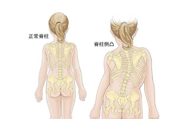 [國康資訊]兒童綜合素質(zhì)測試儀早發(fā)性脊柱側凸-兒童顯著(zhù)的成長(cháng)和發(fā)育障礙